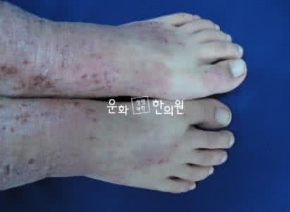 吡美莫司乳膏治疗什么 吡美莫司乳膏多少钱 治疗异位性皮炎效果好吗