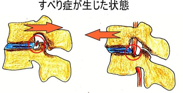 腰椎滑脱椎管狭窄 【图说】 腰椎间盘突出/腰椎滑脱/椎管狭窄【图说】