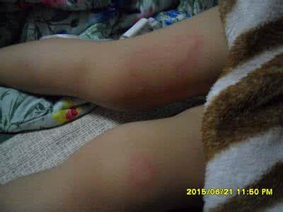 起扁疙瘩发痒怎么回事 大红扁疙瘩怎么回事?