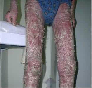 哪种方法治疗红皮病好 红皮病 这是一种什么病症