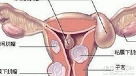 子宫肌瘤恶性是癌症吗 恶性子宫肌瘤是癌症吗 把这种虫子送进子宫多年癌症治好了