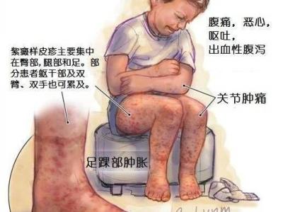 引起血小板减少的疾病 血小板减少 血小板减少的疾病