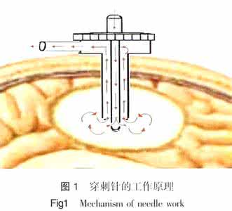 脑出血钻孔引流术 激光辅助脑出血钻孔引流术