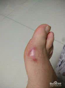 糖尿病足用什么药 糖尿病足是什么 糖尿病足的早期症状与治疗