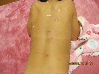 水痘能自愈吗 成人水痘能自愈吗？