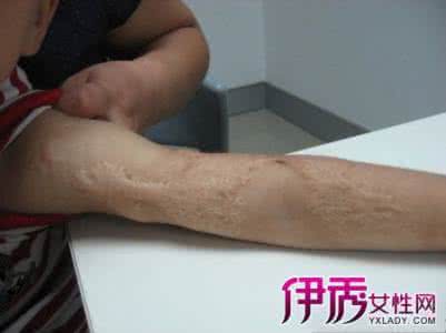 烫伤疤痕的治疗方法 烫伤疤痕治疗方法 烫伤的治疗方法相关