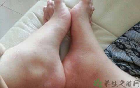 老年人下肢水肿的原因 老年人下肢浮肿怎么办