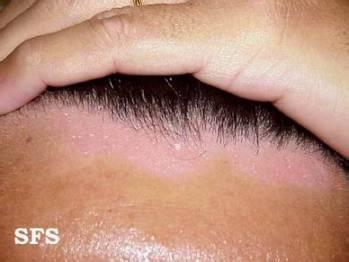 脂溢性皮炎吃什么药 脂溢性皮炎散 脂溢性皮炎吃什么药