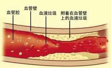 原来清洗血管这么简单 清洗血管原来这么简单！