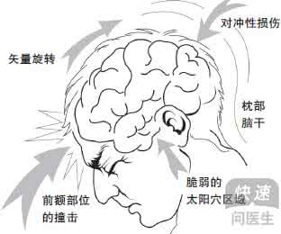脑震荡的症状怎么治疗 脑震荡是什么 脑震荡的症状和治疗手段