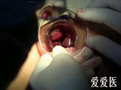 长痔疮会自然好吗 长痔疮会自然好吗 长了痔疮,可以自然分娩吗?