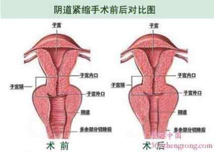 最有效简单的缩阴偏方 哪种缩阴方法是最简单有效的？：中断小便法