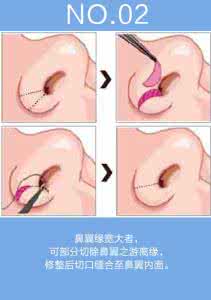 大鼻头整形常识 大鼻头整形常识 整形手术前一定要了解的常识