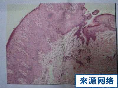 钱币状湿疹的治疗 钱币状湿疹 钱币状湿疹的偏方