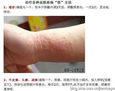 消化系统疾病常见症状 疾病症状 6种常见的怪病症状