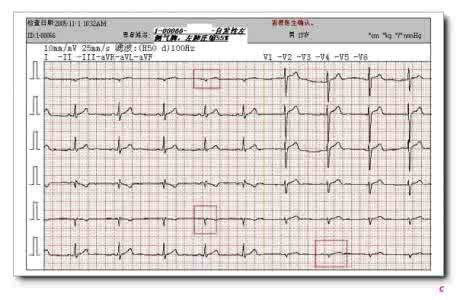 山羊老师心电图讲座 山羊老师课程常见心电图基础知识讲座第九讲——有关Q波知识