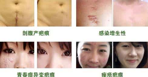 去除手术疤痕的方法 去除手术疤痕 去手术疤痕的方法