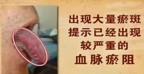 脚上血管鼓起 脚上血管鼓起 身上此处颜色越深,心脏血管堵得越厉害!逆转法在脚上,别错过~