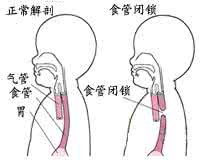 先天性食管闭锁 先天性食管闭锁 10 分钟掌握先天性食管闭锁的诊断和治疗