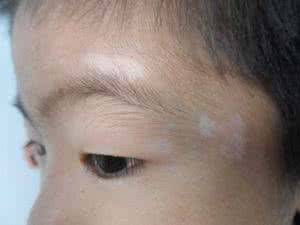 什么狗容易得皮肤病 什么皮肤容易得白癜风?