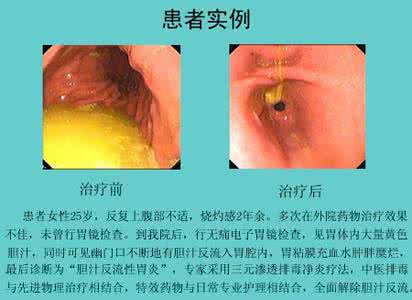 胆汁反流吃什么药最好 胆汁反流性胃炎吃什么食物好