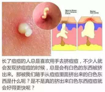 为什么喜欢挤痘痘 为什么我们喜欢挤痘痘