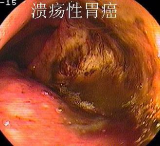 脆弱拟杆菌 脆弱拟杆菌 脆弱拟杆菌_癌症的人可以吃什么好