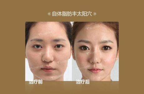 丰胸专家 王明利 丰太阳穴专家 王明利. 丰太阳穴的相关知识