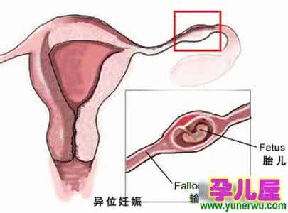 输卵管妊娠常见原因 输卵管妊娠 引起它的原因有哪些