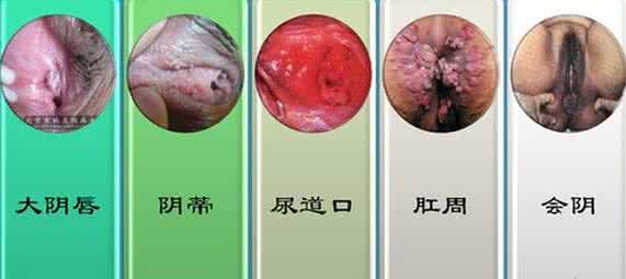 女性尖锐复发是为啥 尖锐湿疣为何总复发