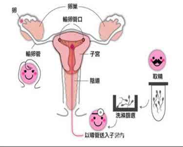 人工受孕要几次才成功 人工受孕成功率