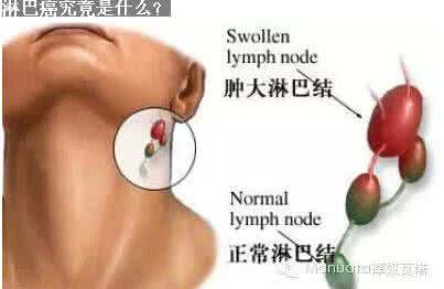 恶性淋巴瘤是不是癌症 恶性淋巴瘤 恶性淋巴瘤变癌症？