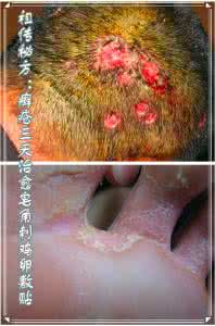 治疗皮肤病的小偏方 强:专治皮肤疾病的妙方