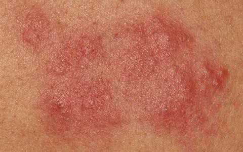 世界过敏性疾病日 7月8日世界过敏日 防过敏性疾病小绝招