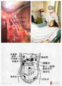 急性阑尾炎的症状 急性阑尾炎的成因 急性阑尾炎的症状与治疗