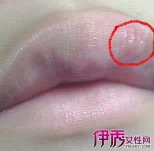 嘴上起泡什么原因 嘴上起泡擦什么?