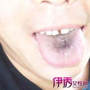 舌头变黑是什么原因 舌头发黑是什么原因 这些因素导致它发黑