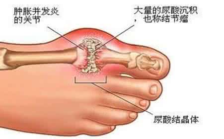 治疗痛风疾病的方法 痛风是严重的疾病吗？