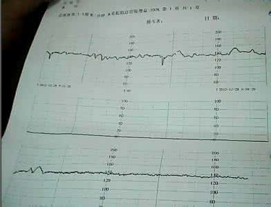 胎心位置判断胎位图片 如何判断胎心监控图？
