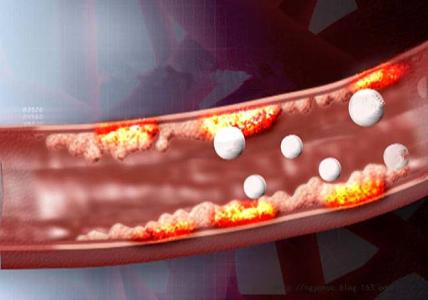 打通血管壁的中药秘方 【名医秘方】将血管壁清理干净的效方,根治心脑血管病