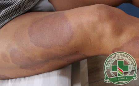 治疗乙肝的最新药物 治疗乙肝的最新药物 牛皮癣最新治疗药