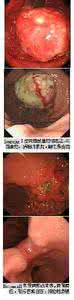 胃癌腹水 胃癌 腹水 胃癌手术后如何避免腹水