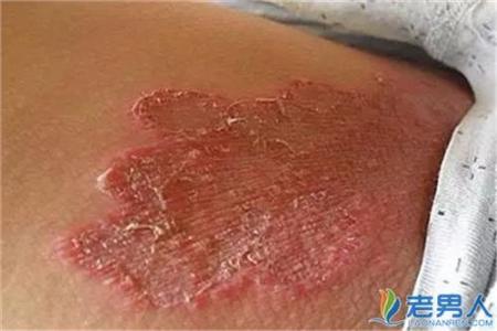 大腿肚内侧股癣图片 大腿肚内侧股癣图片 大腿肚内侧股癣怎么办？