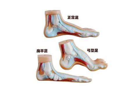扁平足的矫正方法 什么是扁平足 扁平足该如何矫正