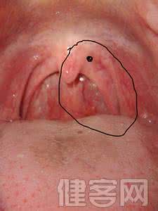 颈椎病家庭自疗挂图 慢性咽炎家庭自疗方法