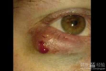 病毒性疱疹怎么治疗 病毒性疱疹 病毒性疱疹怎么治疗