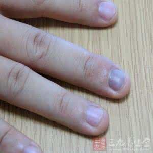 真菌性皮肤病的治疗 真菌性皮肤病 几种常见的真菌性皮肤病