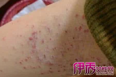 妇科支原体感染的症状 妇科支原体感染症状 妇科支原体感染怎么办
