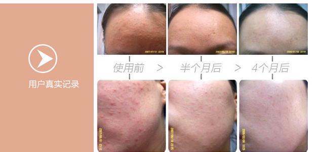 闭合性粉刺 清洁按摩双管齐下 封杀闭合性粉刺