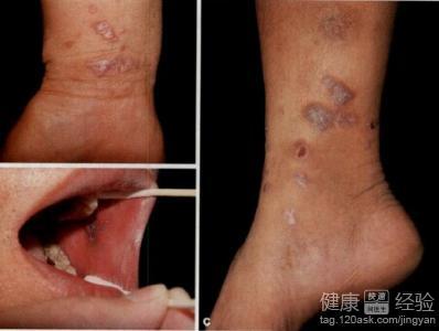 扁平苔藓能去除吗 扁平苔藓能去除吗 怎么去除苔藓？